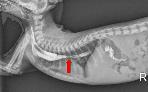 HẸP THỰC QUẢN (ESOPHAGEAL STRICTURES / ESOPHAGEAL STENOSIS)
