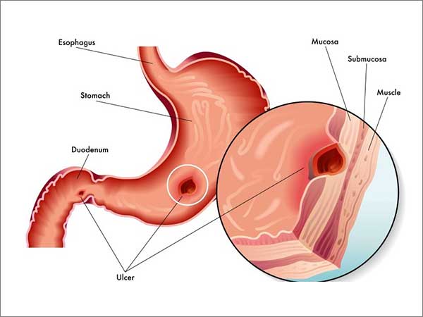LOÉT DẠ DÀY - TÁ TRÀNG TRÊN ĐỘNG VẬT NHỎ (GASTRISTINAL ULCERS IN SMALL ANIMALS)