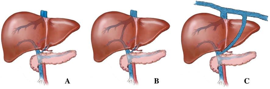 BỆNH THÔNG CỬA - CHỦ (LIVER SHUNT) Ở CHÓ